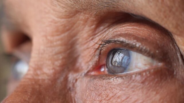 Extreme close up of elderly woman eyes with cataract looking away and blinking slowly