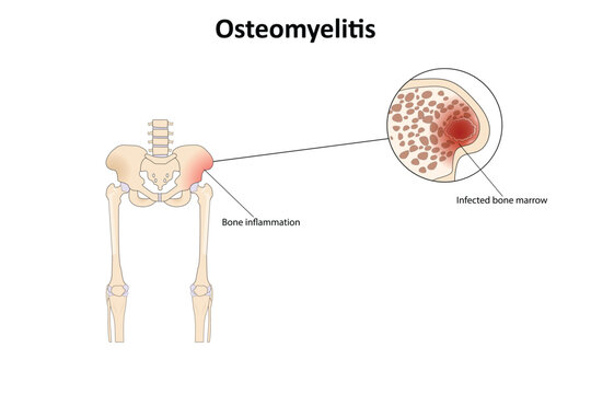 Osteomyelitis vector illustration