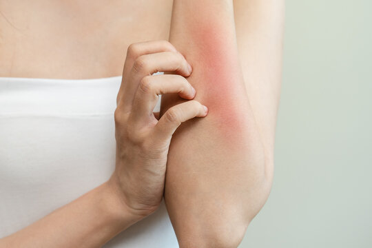 Dermatology, asian young woman reaction from atopic, insect bites on her arm, hand in scratching itchy red spot or rash of skin. Healthcare, treatment of beauty.