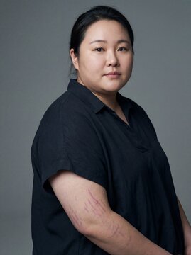 Cushing&rsquo;s Syndrome: Professional photography, portrait of a person with a "moon face" (rounded) and visible purple stretch marks on skin, neutral background, soft professional lighting.