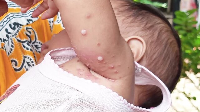 Chickenpox is caused by the highly contagious Varicella-zoster virus, generally affecting children, with the main sign being the appearance of a very itchy, reddish skin rash with blisters.