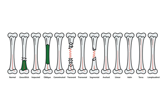 Bone fracture types illustrated in a medical diagram with labels