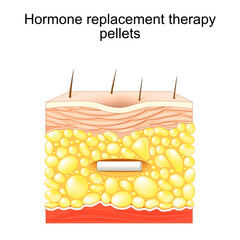 Hormone replacement therapy pellets. skin with Hormonal pellet in fat layer