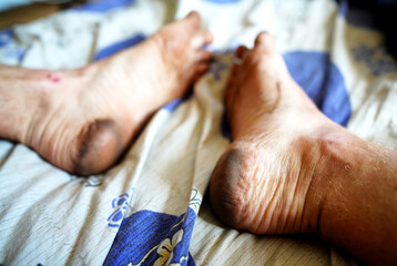 Dirty feet on bed with patterned blanket in bright light during daytime in flat. Two pairs of dirty feet are visible on bed sheets of bed. 