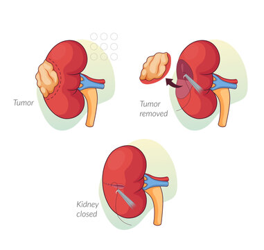 Kidney Tumor Removal Surgical Procedure - Stock Illustration