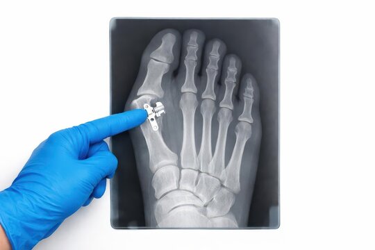 A gloved finger indicates the X-ray of a front foot following Hallux Valgus surgery against a white background