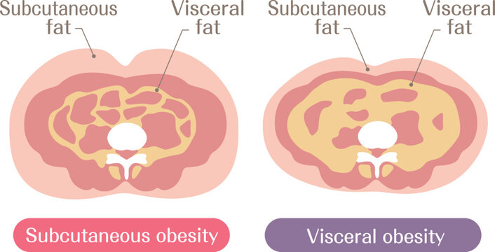 Subcutaneous Fat and Visceral Fat Obesity Types Comparison Illustration