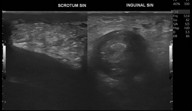Scrotal ultrasound with color Doppler evaluation demonstrates features suggestive of inguinoscrotal hernia with associated vascular compromise, raising suspicion for testicular torsion. Doppler assess