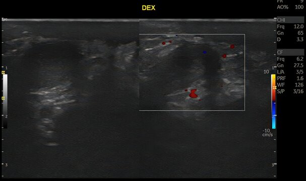 Scrotal ultrasound with color Doppler evaluation demonstrates features suggestive of inguinoscrotal hernia with associated vascular compromise, raising suspicion for testicular torsion. Doppler assess