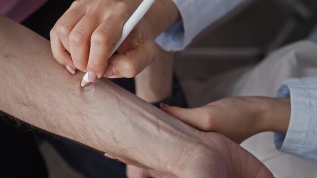 Closeup b roll of professional dermatologist outlining mole on male patient arm with white pencil during medical consultation in clinic office