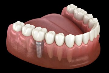 Fototapeta premium 3D Dental Implant Anatomy Illustration