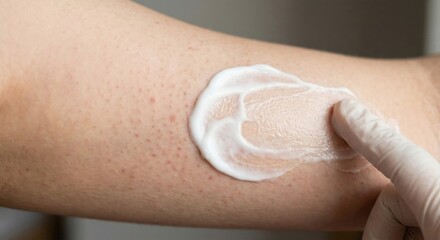 Fototapeta premium Applying dermatological cream to keratosis pilaris on arm
