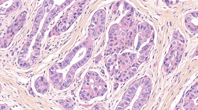 Invasive ductal carcinoma tissue cross-section with irregular glandular structures