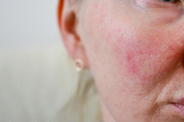 Red irritated skin with rosacea and visible pores on female cheek close up