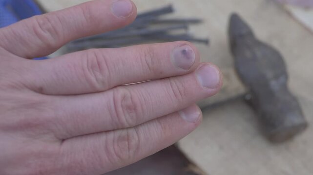 Close up of nail injury showing hematoma caused by blunt trauma. Bruise reflects accident during physical task. Out-of-focus tools such as hammer and nails highlight labor-related context