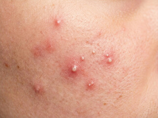 Fototapeta premium Extreme macro close-up of skin with acne and whiteheads, inflamed red pimples on cheek, dermatology problem skin texture, oily skin with breakout