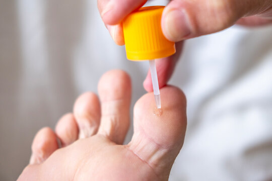 person's foot receiving topical treatment wart or skin lesion close-up, medical therapy with salicylic acid, verruca removal, skin lesion healing, skin recovery, dermatologic care