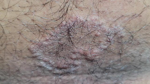Close-up of ringworm fungal infection on human abdomen skin
