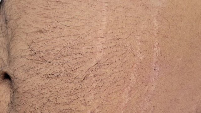 Close-up of vertical stretch marks on male abdomen skin
