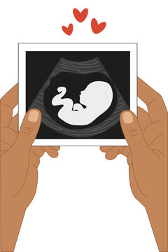 A woman's hands hold a screening photo. The photo shows a baby in early pregnancy. The photo shows the baby's embryo