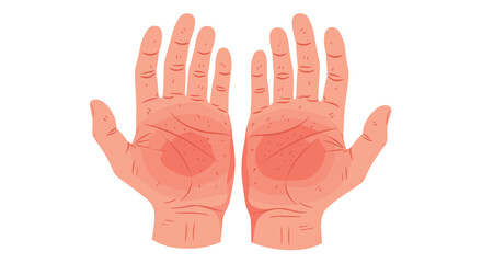 Fototapeta premium Two human palms with red irritated skin and circular rash patterns are shown against a plain white background.