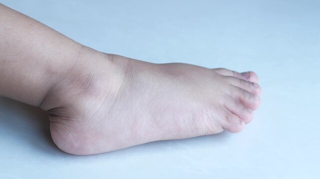 Close up view of swollen foot with edema showing on white background, medical condition