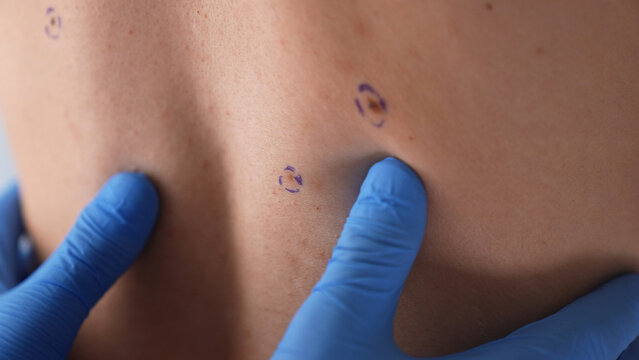 Dermatologist in blue gloves examines a marked mole on a hairy male back during skin cancer screening and plastic surgery consultation.
