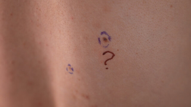 Closeup of a small mole on human skin, circled with marker and marked by a question mark, symbolizing suspicious lesion, dermatology examination and skin cancer screening.