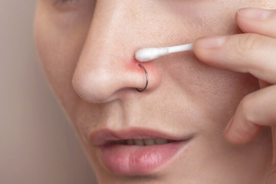 An inflamed nose piercing. A woman swabbing the piercing site with chlorhexidine on a cotton swab. Post-piercing care. Close up photo