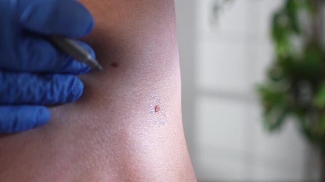 Dermatologist in blue gloves examines a mole on a hairy male torso during skin cancer screening and plastic surgery consultation.