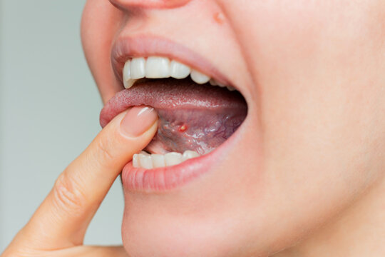 Young woman showing close-up aphthous ulcer of stomatitis in the acute stage on the mucous membrane of the tongue.