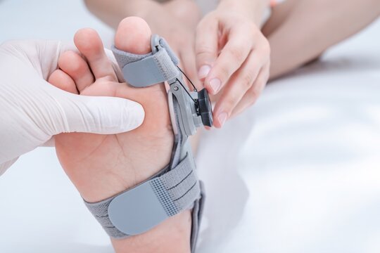 Close up view on orthopedist examines leg with hallux valgus deformity of big toe in orthopedic bandage