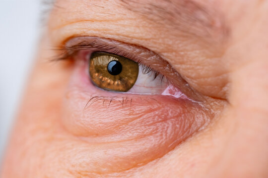 female eye with visible redness, severe swelling, periorbital edema, inflammatory process, allergic, infectious eye condition, ocular inflammation and trauma, ophthalmology blepharitis, conjunctivitis