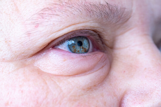 female eye with visible redness, severe swelling, periorbital edema, inflammatory process, allergic, infectious eye condition, ocular inflammation and trauma, ophthalmology blepharitis, conjunctivitis