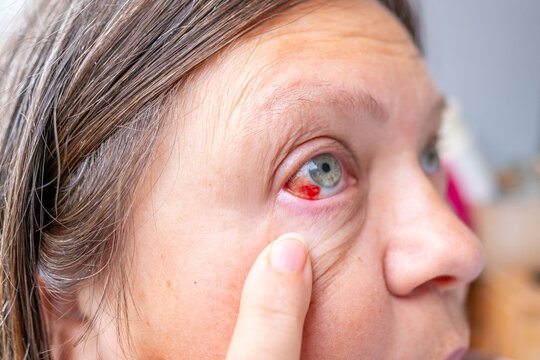 Close-up human eye with severe redness and broken blood vessels, showing subconjunctival hemorrhage, clinical detail for medical, health, and ophthalmology concepts, patient healing, blood vessel