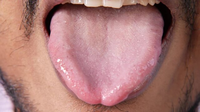 Extreme close up of young man sticking out pink tongue with white coating for medical examination