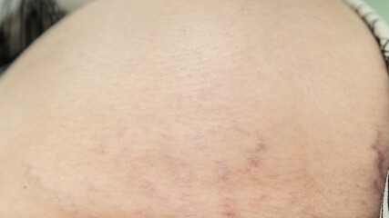 Close up of stretch marks on skin during pregnancy, showing natural body changes, dermatology concept, postpartum recovery and maternal skincare.