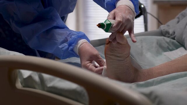 Doctor Cleaning Diabetic Foot Ulcer with Sterile Gauze. Medical Treatment of Chronic Diabetic Foot Wound. Diabetes treatment