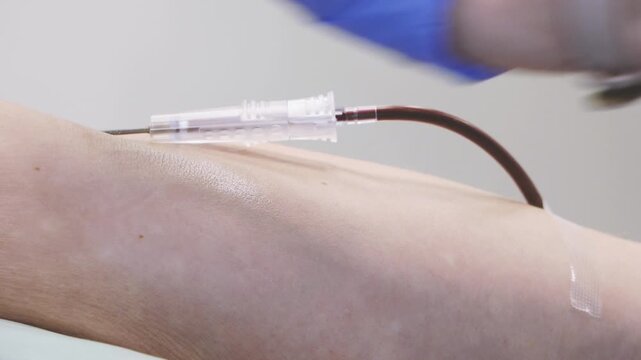 Detailed close-up of a medical needle inserted into a donor&rsquo;s arm with transparent tubing attached, highlighting the blood donation or intravenous procedure in a clinical setting.