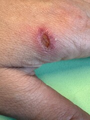 Close-up of a small wound with scab and redness on the skin of a woman's hand