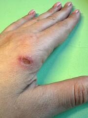 Fototapeta premium large burn on a woman's hand on a light green background