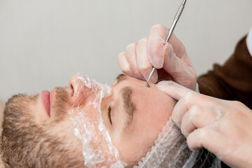 Cosmetologist uses comedone extractor to thoroughly remove blackheads for male patient. Facial...