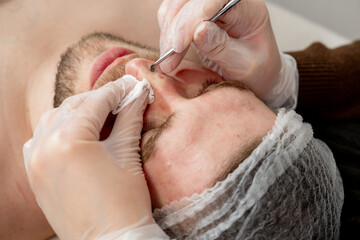 Cosmetologist uses comedone extractor to thoroughly remove blackheads for male patient. Facial procedure and treatment in dermatology or aesthetic clinic 