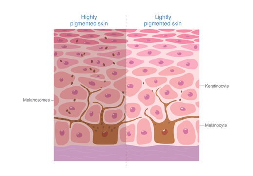 Comparison of highly pigmented and lightly pigmented skin. Melanocytes transfer melanin to surrounding skin cells. Difference skin tone while similar epidermal structure. hyperpigmentation.
