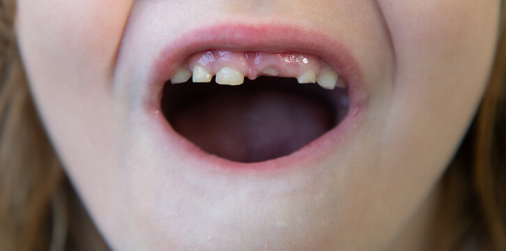 Child with tooth gap. Closeup of child mouth with missing tooth. Kid showing new teeth growing. Toothless kids smile. Child losing teeth.