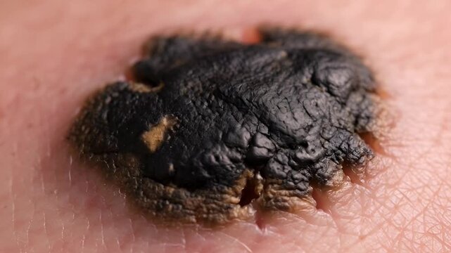 Extreme close-up of melanoma warning sign on skin, asymmetrical dark mole with irregular borders and varied pigmentation