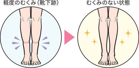 軽度のむくみ（靴下跡）からむくみのない状態への変化