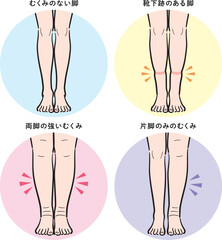 脚のむくみの種類セット