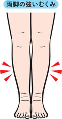 両脚の強いむくみ