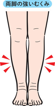 両脚の強いむくみ